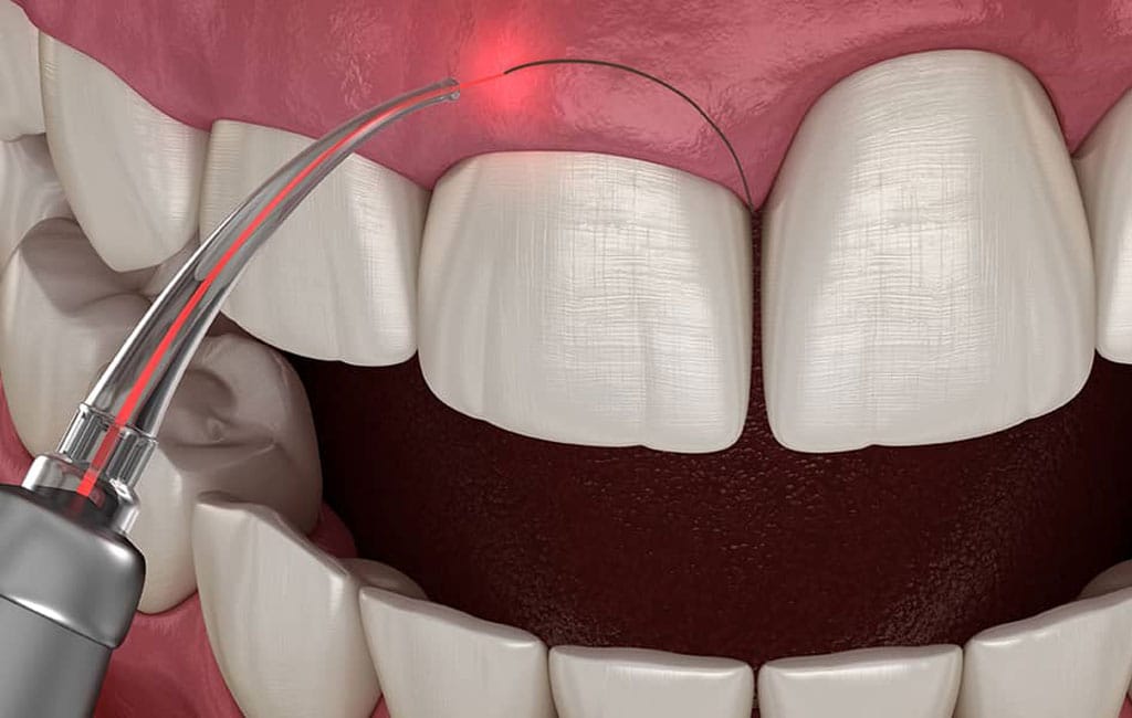 جراحی لثه با لیزر