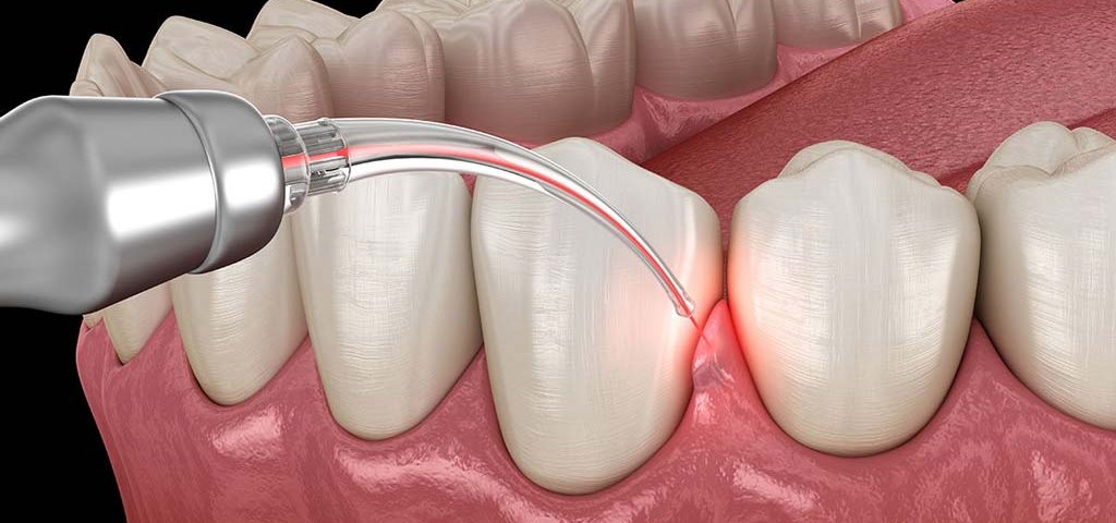 جراحی لیفت لثه چیست؟