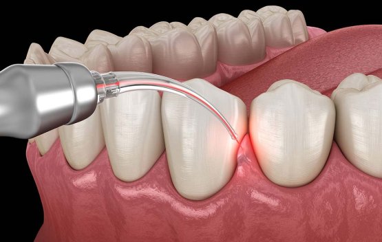 جراحی لیفت لثه چیست؟