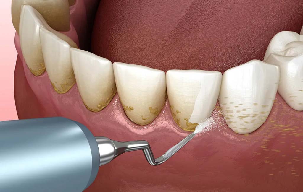 مزایا و مراقبت های جراحی فلپ لثه