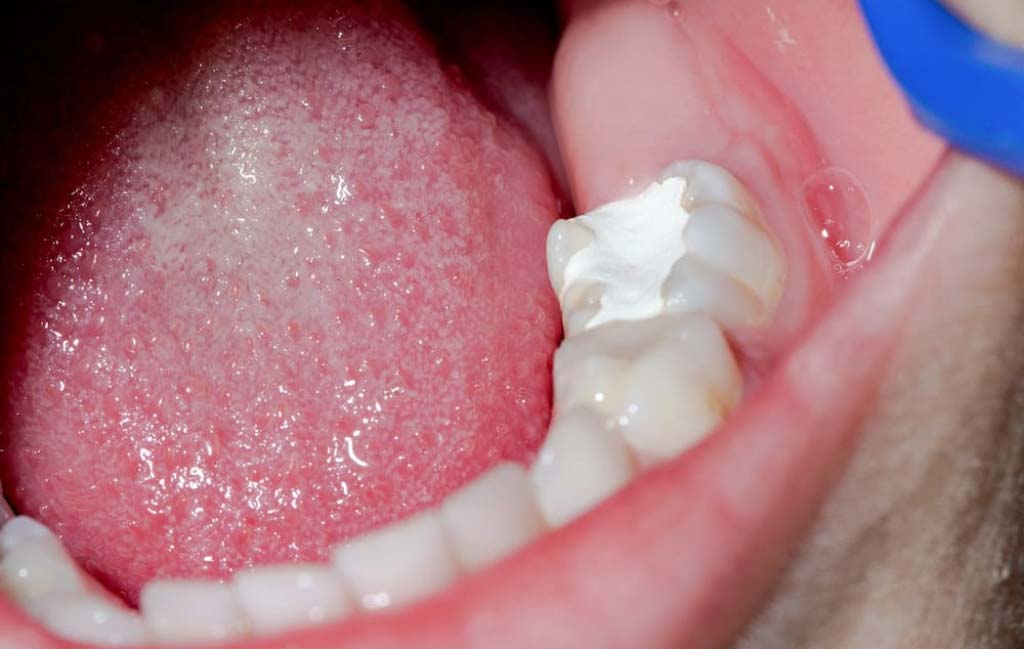 عوامل موثر بر هزینه پر کردن دندان