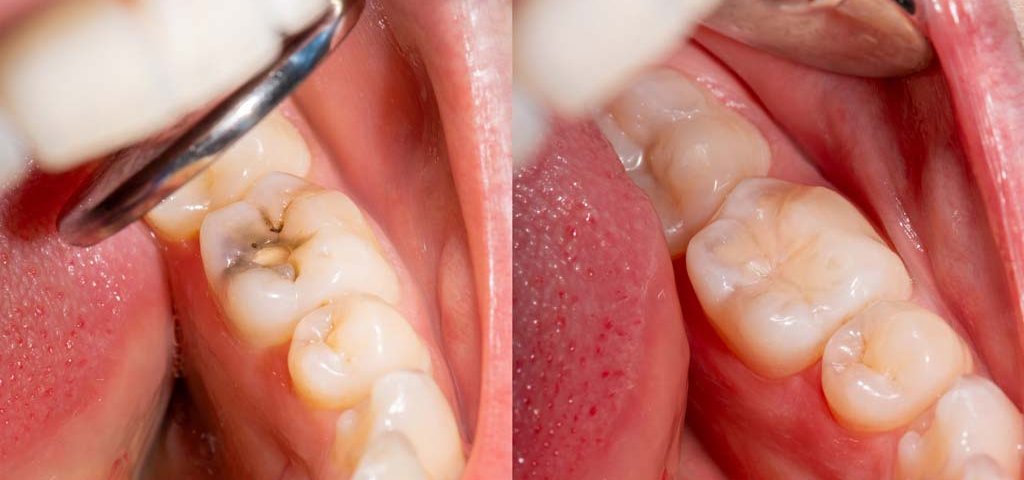 پر کردن دندان در صادقیه تهران