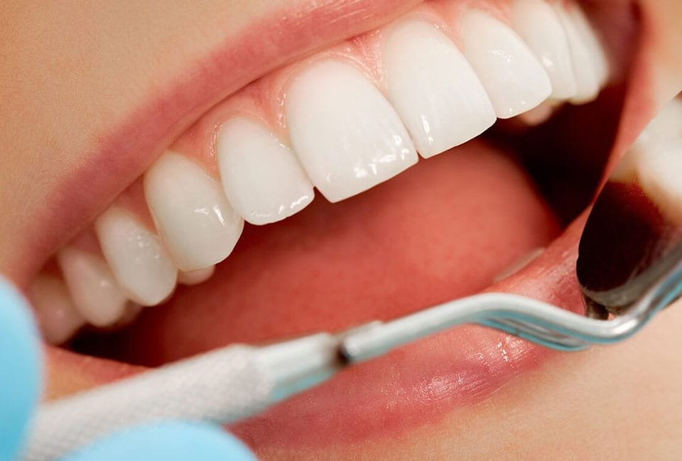 کامپوزیت IPS چیست؟