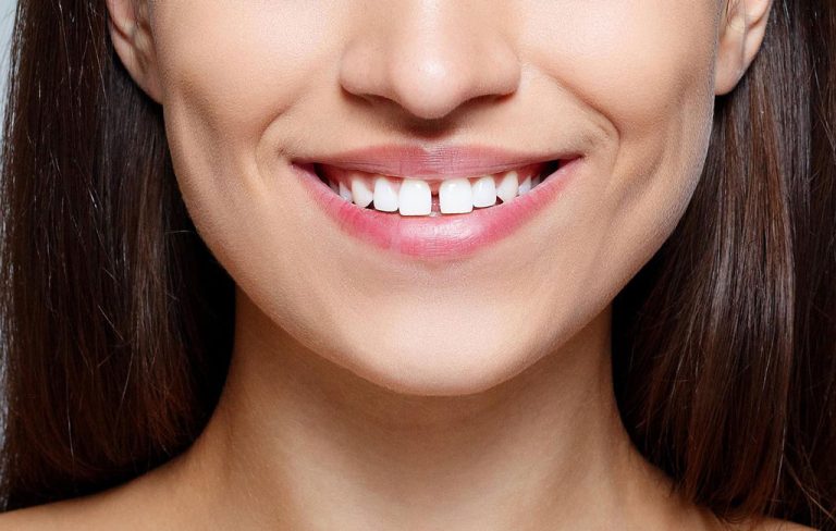 اصلاح دندان خرگوشی با کامپوزیت