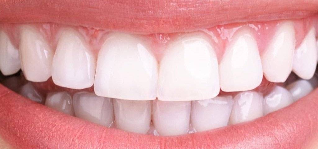 تراشیدن دندان برای کامپوزیت