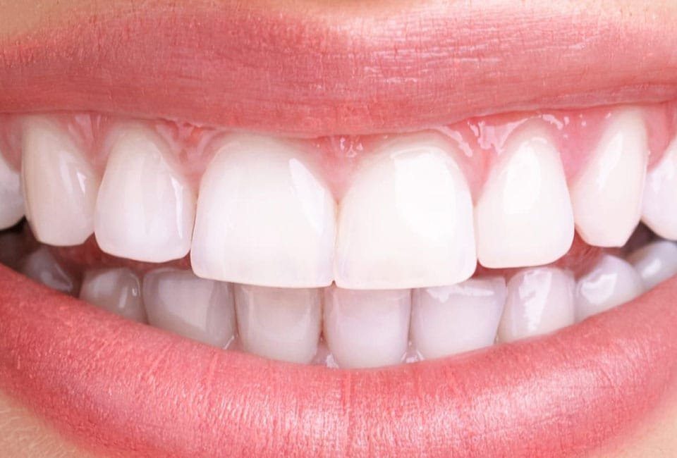 تراشیدن دندان برای کامپوزیت