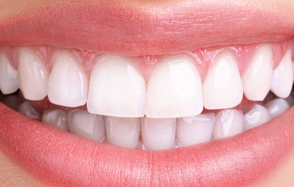 تراشیدن دندان برای کامپوزیت