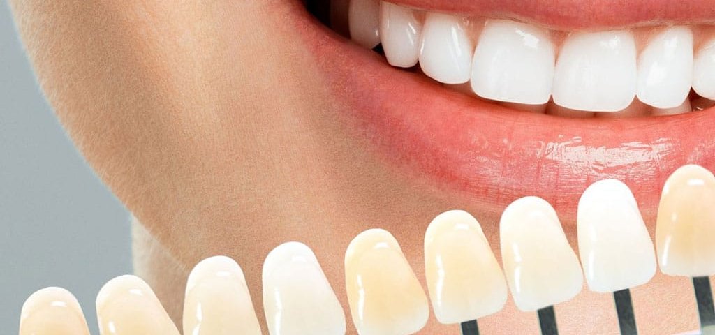 کامپوزیت دندان چقدر طول می‌کشد؟