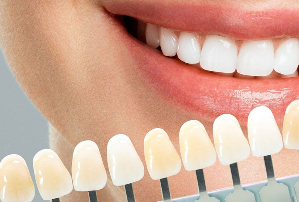 کامپوزیت دندان چقدر طول می‌کشد؟