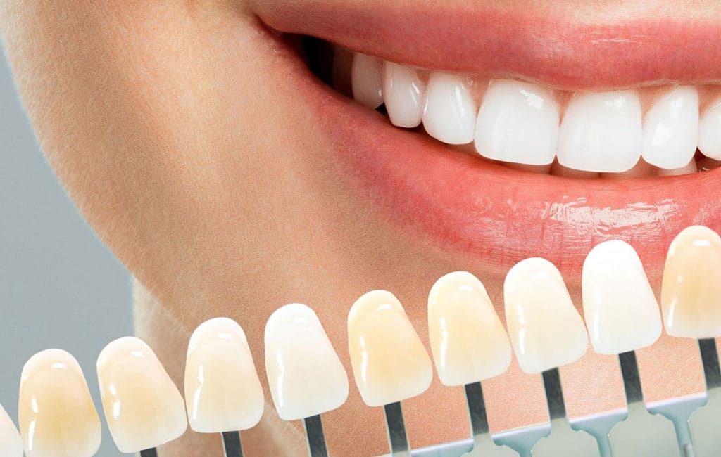 کامپوزیت دندان چقدر طول می‌کشد؟