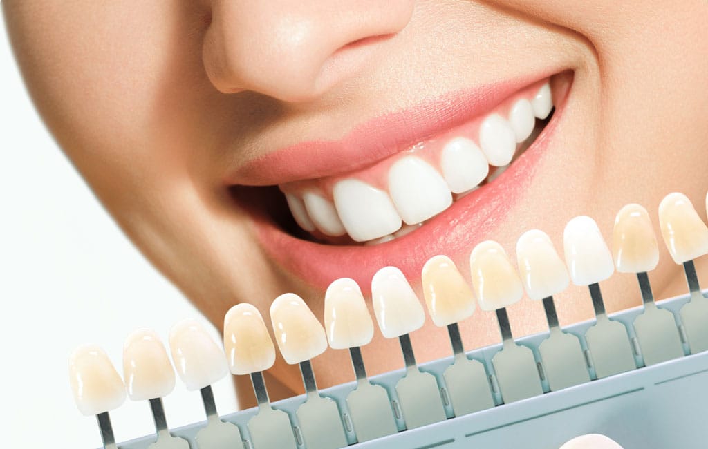 انواع مدل های کامپوزیت دندان