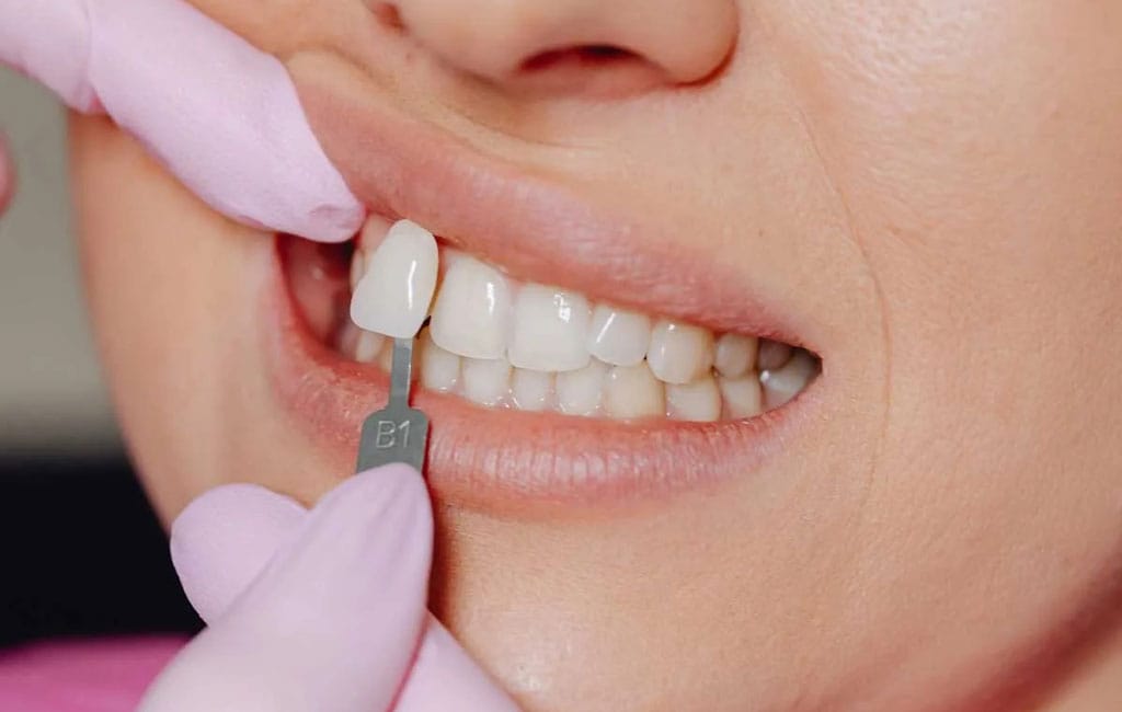 برای حفظ سفیدی دندان چه نکاتی را باید رعایت کنیم؟