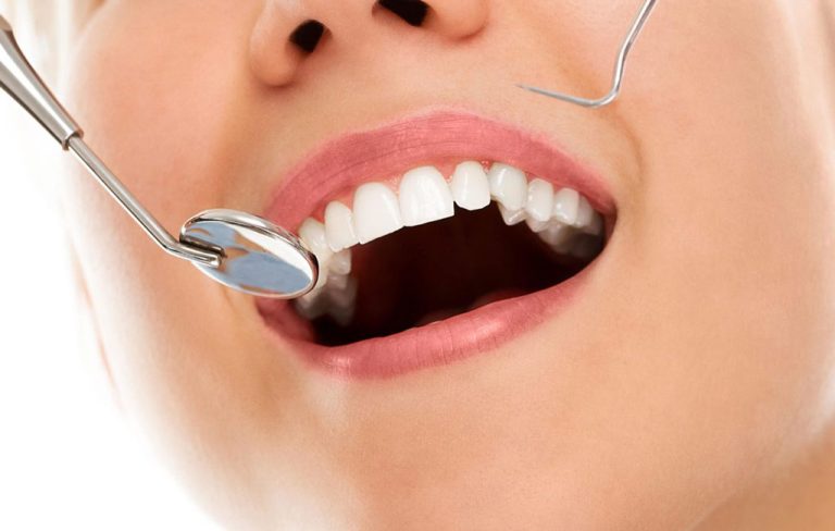 چگونه کامپوزیت دندان را سفید کنیم؟