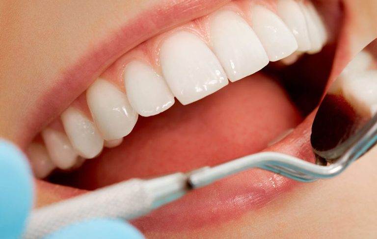 کامپوزیت IPS چیست؟