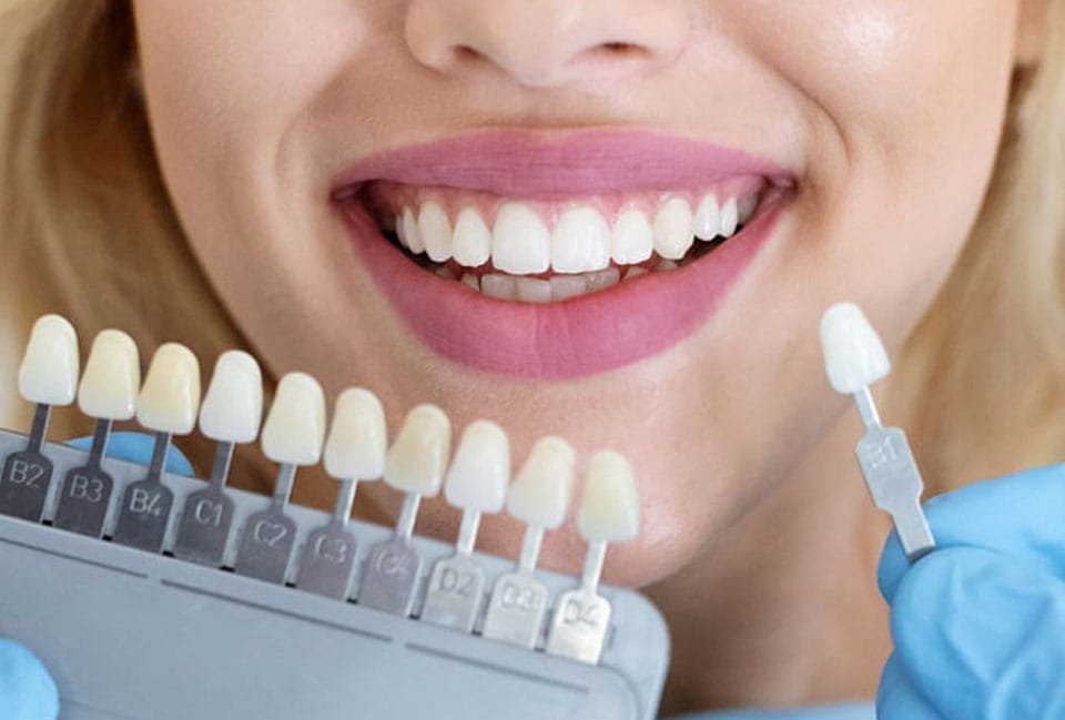 کدام کامپوزیت دندان بهتر است؟