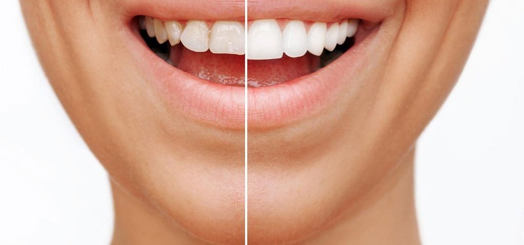 جرم‌ گیری کامپوزیت دندان