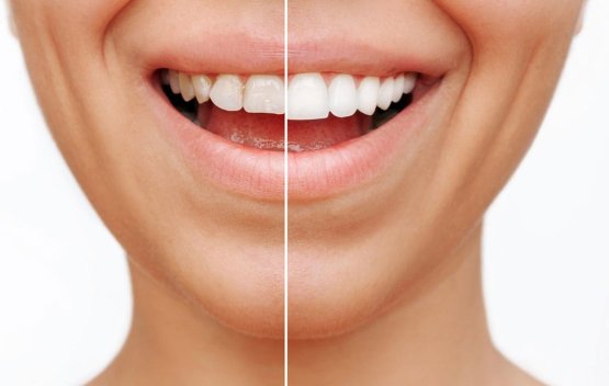 جرم‌ گیری کامپوزیت دندان