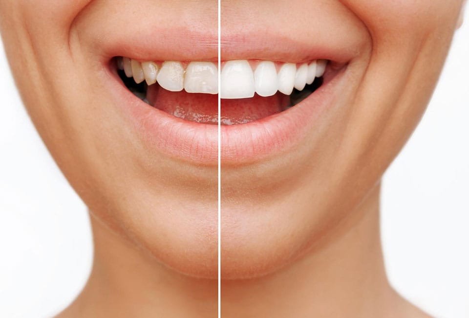 جرم‌ گیری کامپوزیت دندان