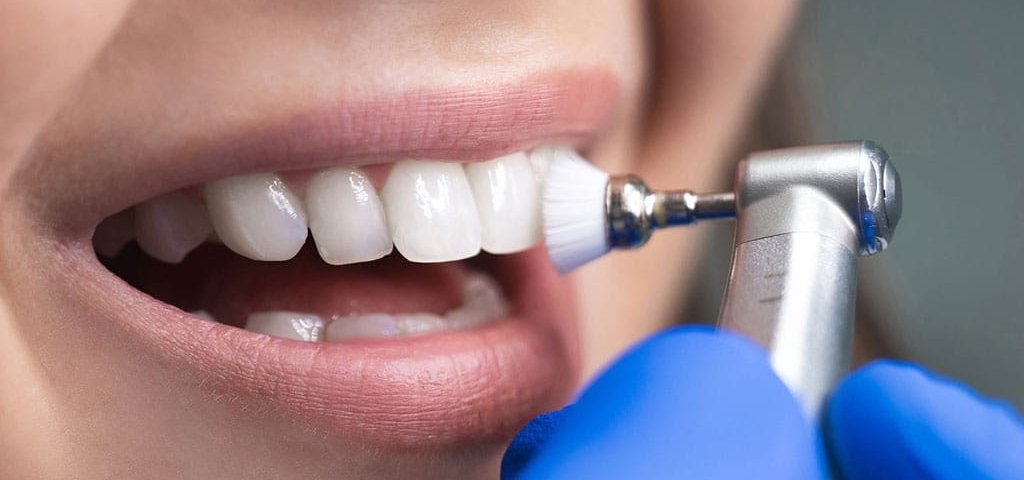 مراقبت بعد از کامپوزیت دندان