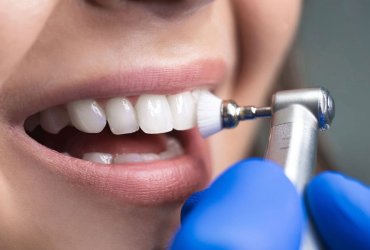 مراقبت بعد از کامپوزیت دندان