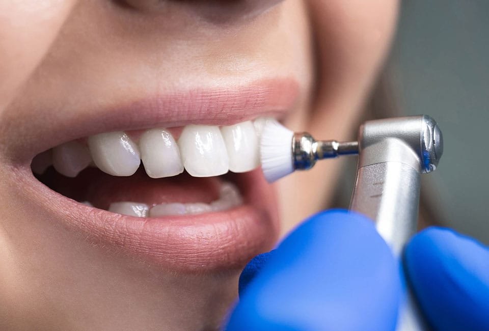 مراقبت بعد از کامپوزیت دندان