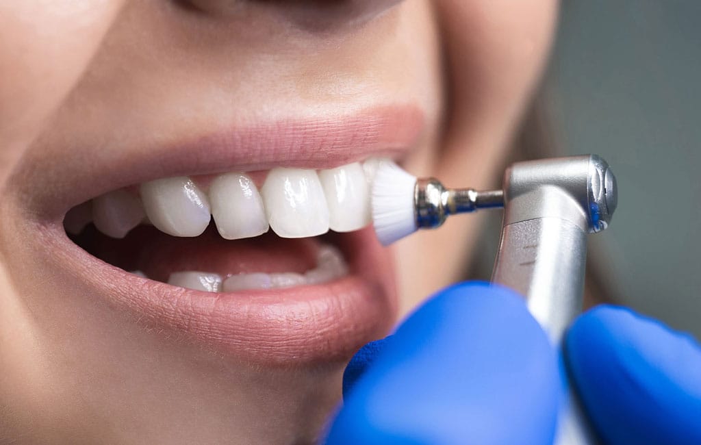 مراقبت بعد از کامپوزیت دندان