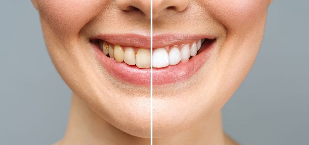 علت زرد شدن کامپوزیت دندان