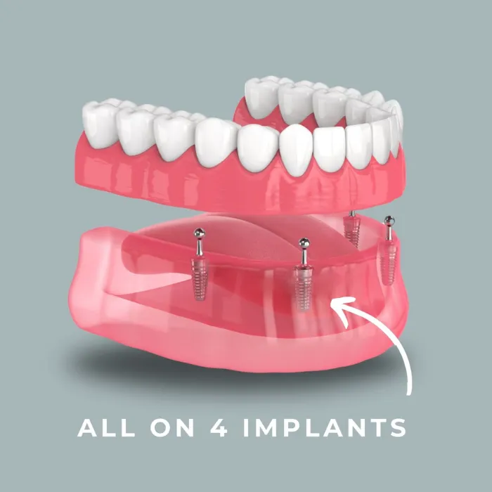 ایمپلنت All-on-4