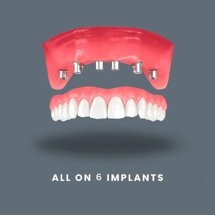 ایمپلنت All-on-6