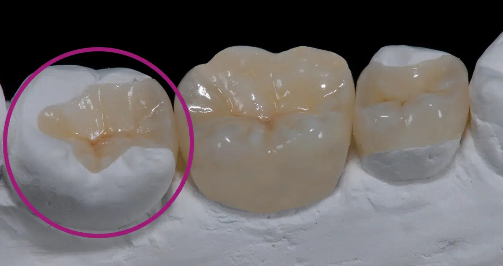 مزایای اینله و آنله دندان