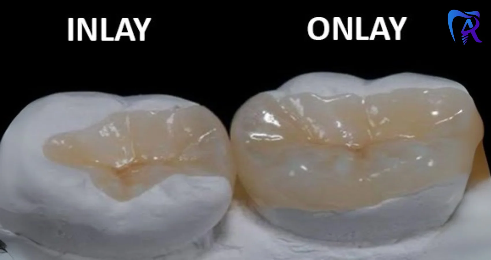 تصویر ترمیم دندان با اینله و آنله دندان