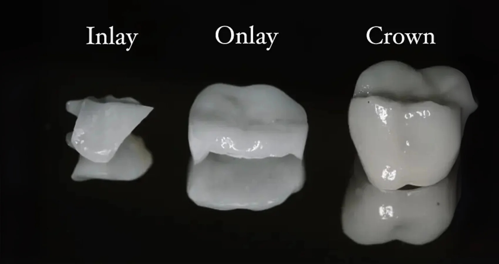 تفاوت اینله و آنله دندان