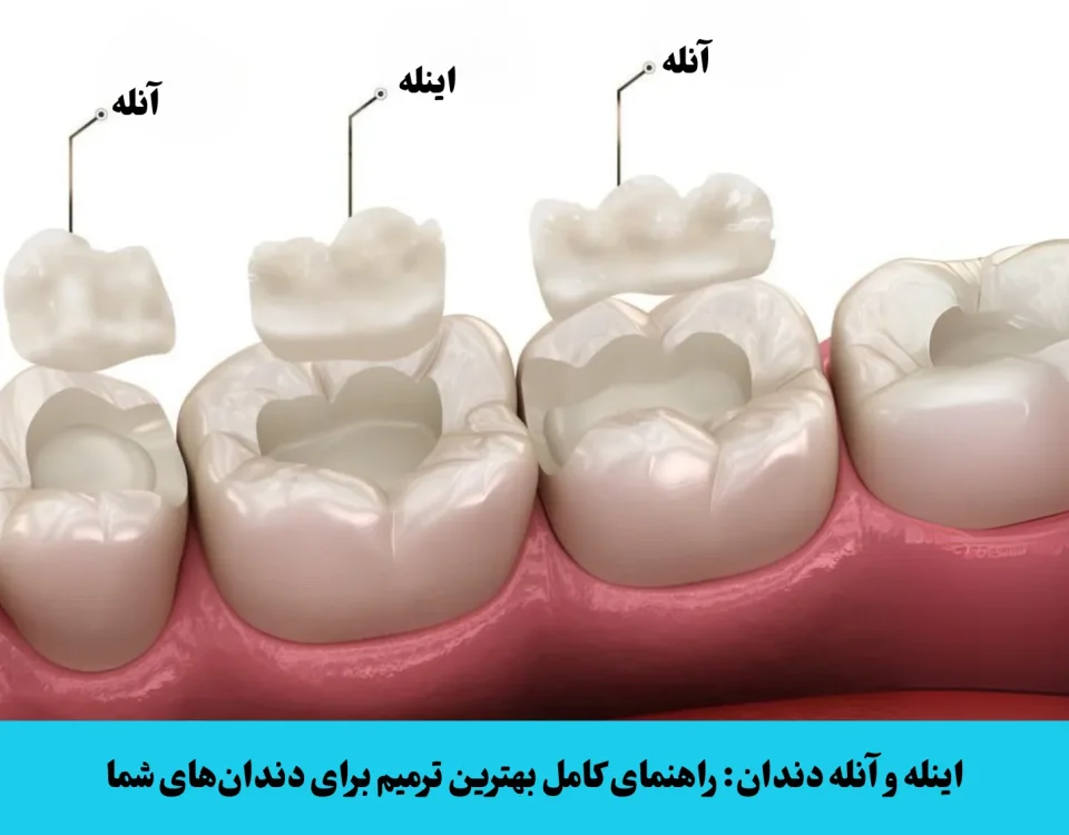اینله و آنله دندان راهنمای کامل بهترین ترمیم برای دندان_های شما | کلینیک دندانپزشکی دکتر امیررضا پدرام در مرزداران