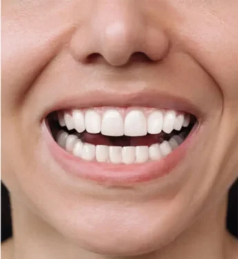 بعد از کامپوزیت دندان دکتر امیررضا پدرام