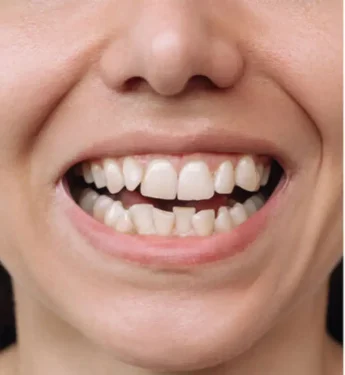 قبل از کامپوزیت دندان دکتر امیررضا پدرام