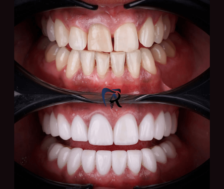 خدمات تخصصی انواع لمینیت دندان (Dental Veneers) با تضمین کیفیت و قیمت مناسب در کلینیک دکتر امیررضا پدارم | مشاوره رایگان و شرایط پرداخت آسان و اقساطی