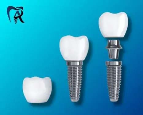 اجزای ایمپلنت دندان (پایه، اباتمنت و روکش) برای روکش ایمپلنت دیجیتالی دندان