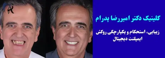 ایمپلنت دیجیتال