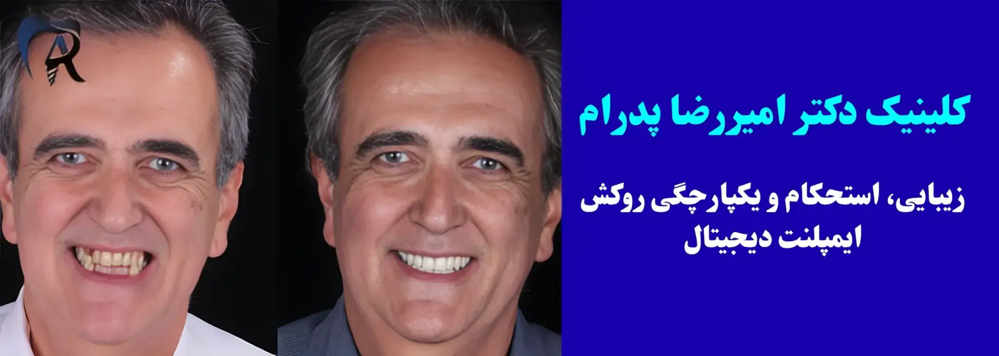 زیبایی، استحکام و یکپارچگی روکش ایمپلنت دیجیتال