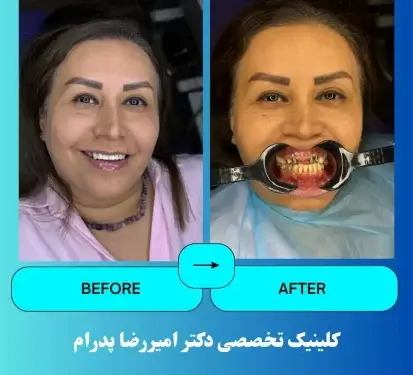 نمونه کار ایمپلنت دندان در کلینیک دکتر امیررضا پدرام -2
