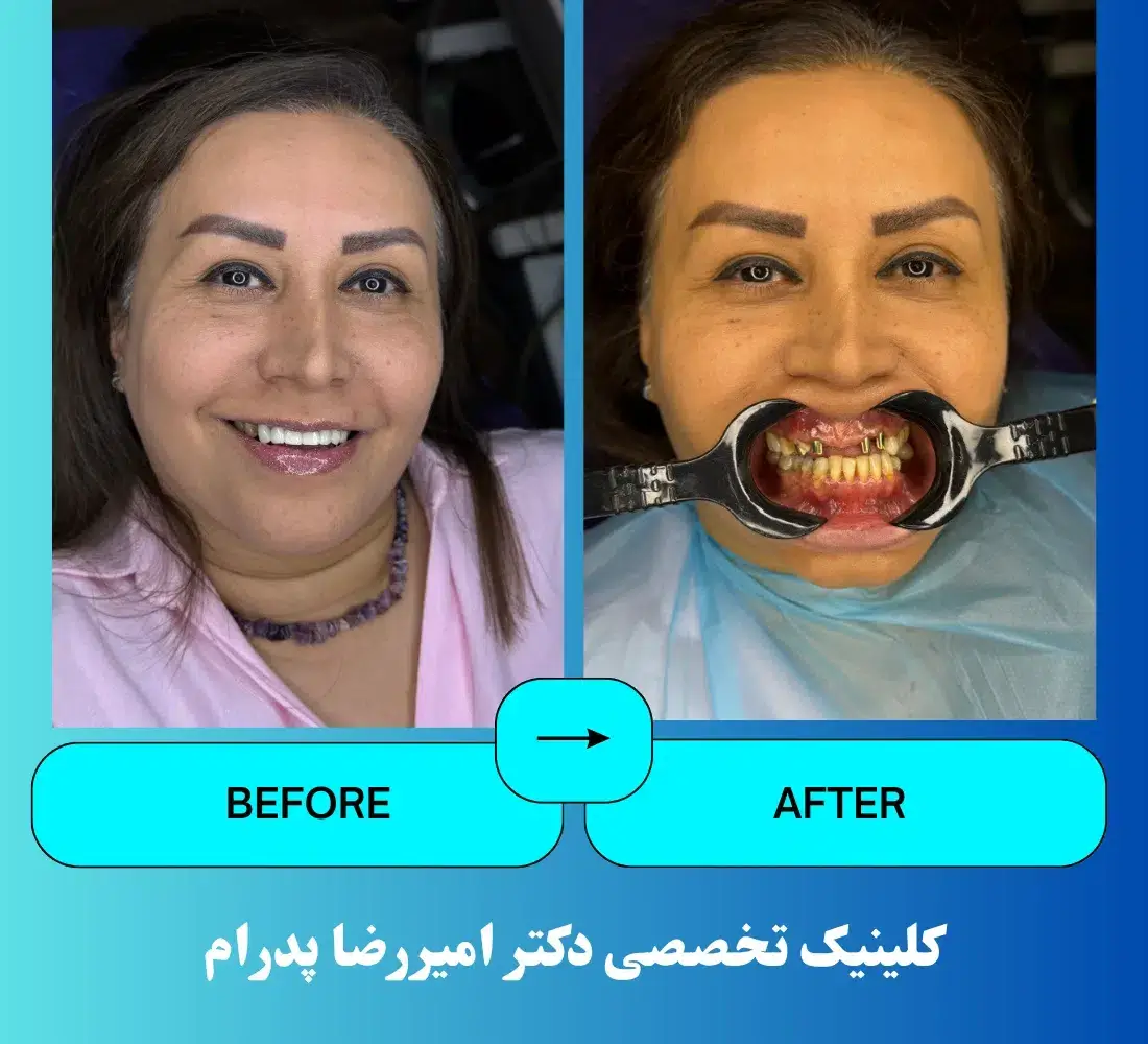 نمونه کار ایمپلنت دندان در کلینیک دکتر امیررضا پدرام -2