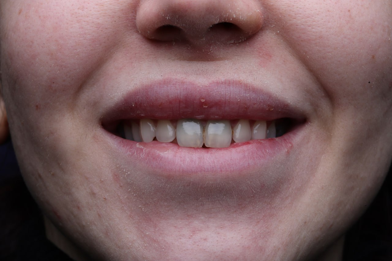 لمینت دندان