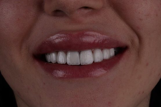 عکس بعد از لمینت دندان
