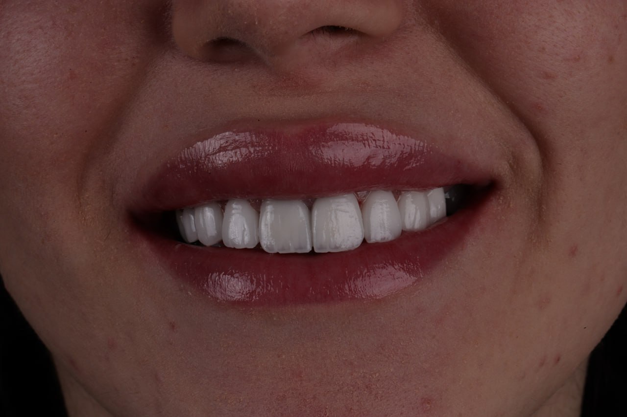 عکس بعد از لمینت دندان