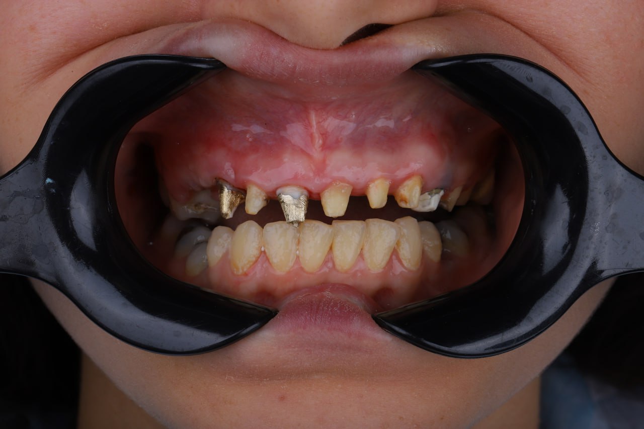  عکس قبل از لمینت دندان