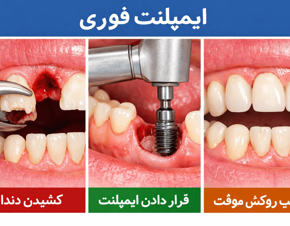 ایمپلنت فوری