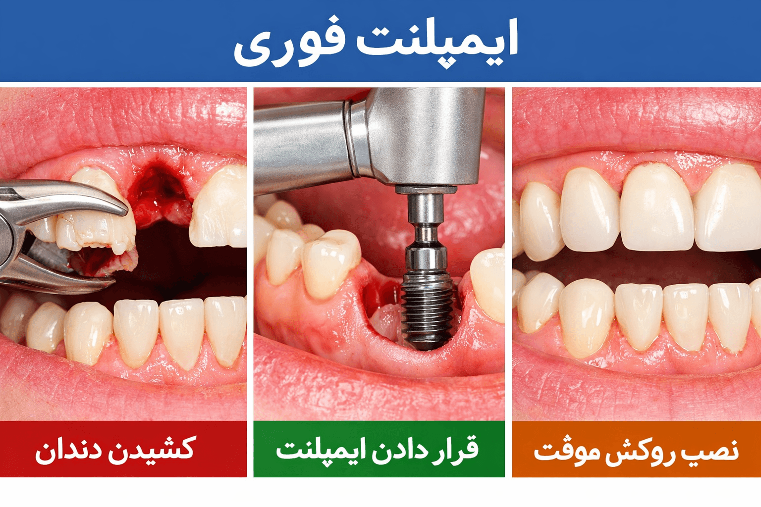 ایمپلنت فوری