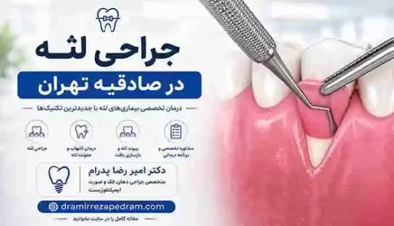جراحی لثه در صادقیه تهران