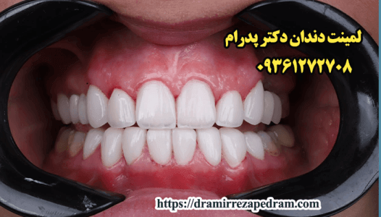 قیمت لمینت دندان