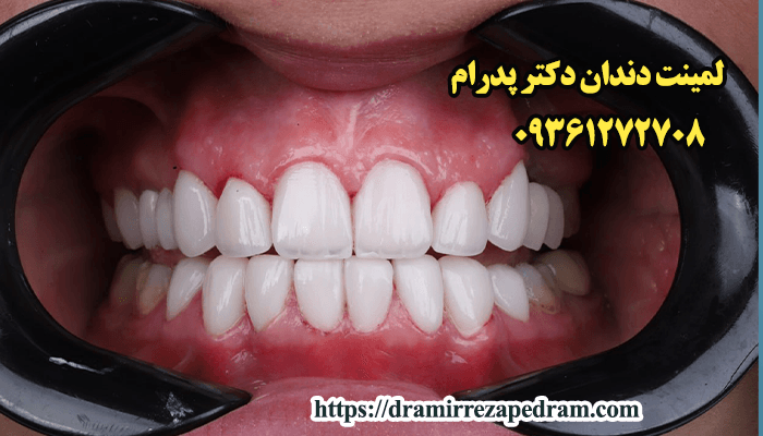 قیمت لمینت دندان